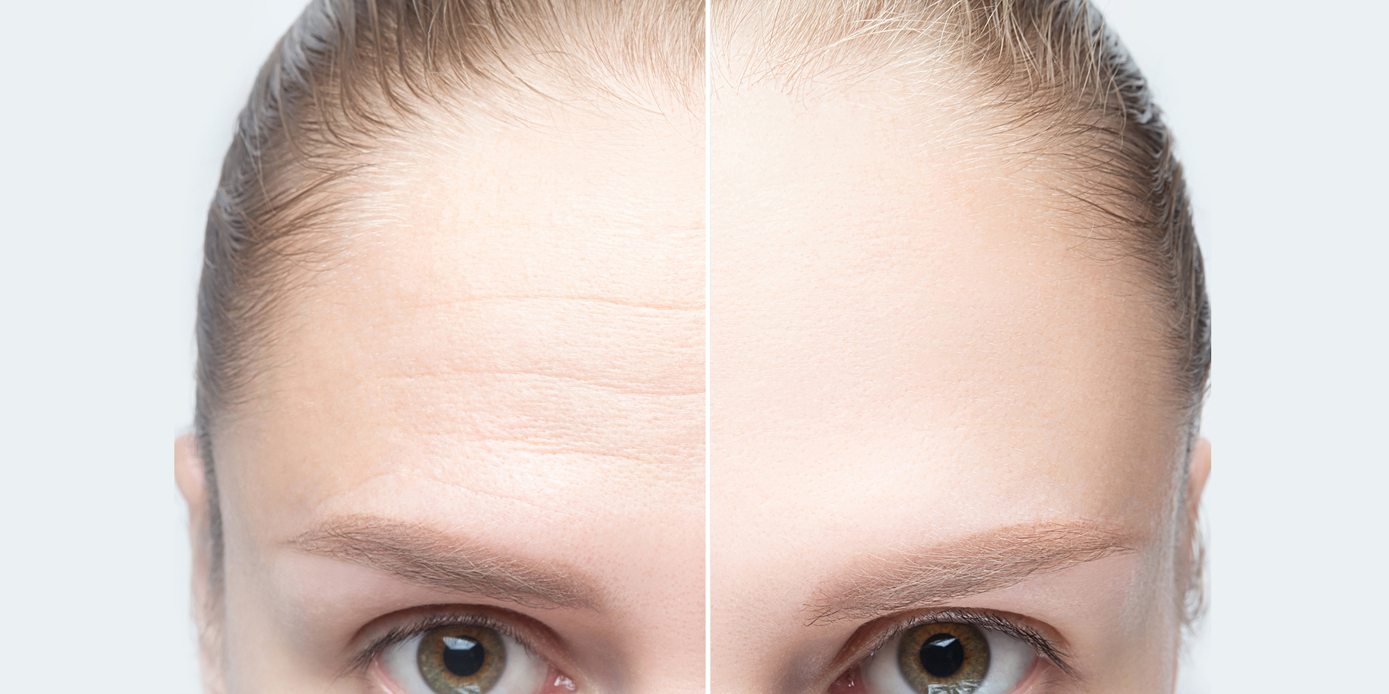 Forehead wrinkles before and after injection, treatment, surgery. Womans face close up.