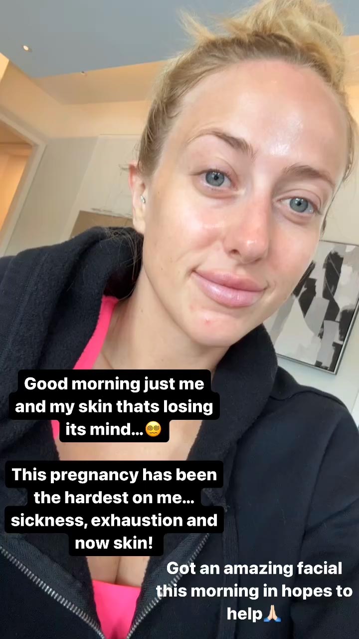 Brittany Mahomes Says Her Skin Is Losing Its Mind Amid Hardest Pregnancy 138