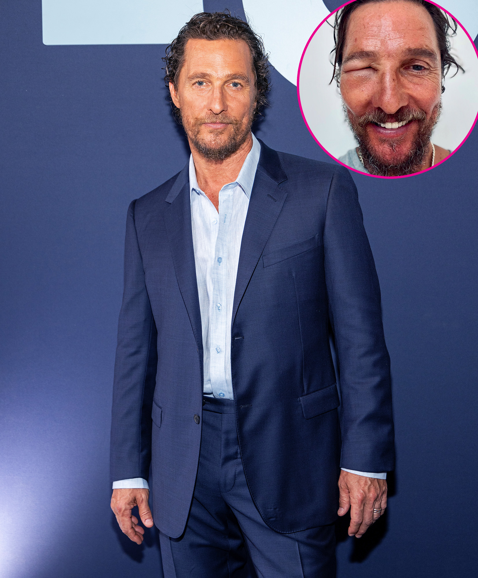 Matthew McConaughey Eye Swollen Shut by Bee