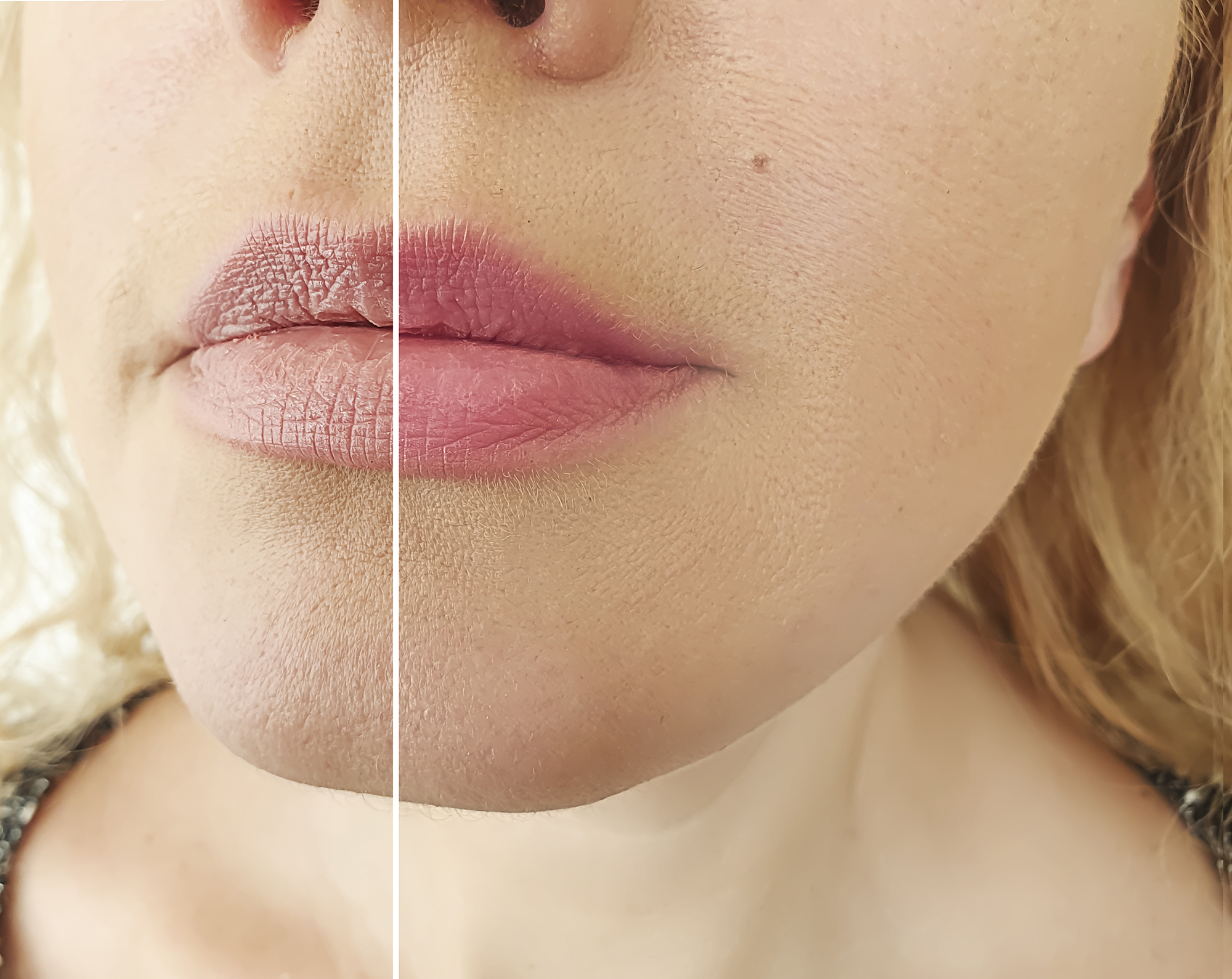 woman face wrinkles before and after correction