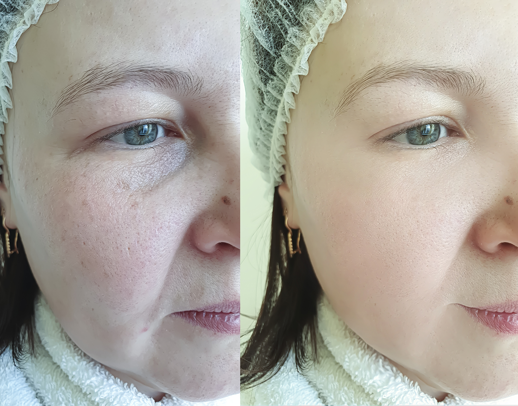 woman face wrinkles before and after treatment