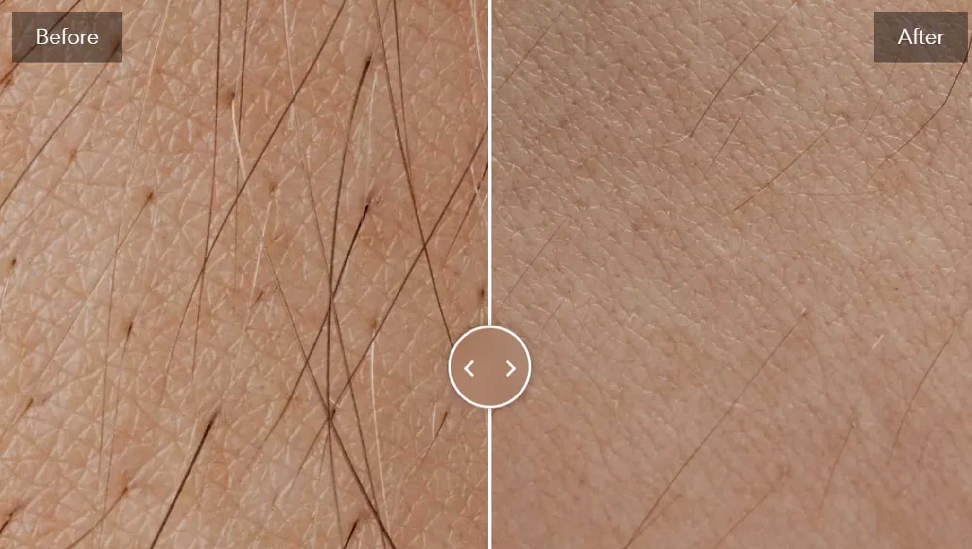 Hair Removal Device