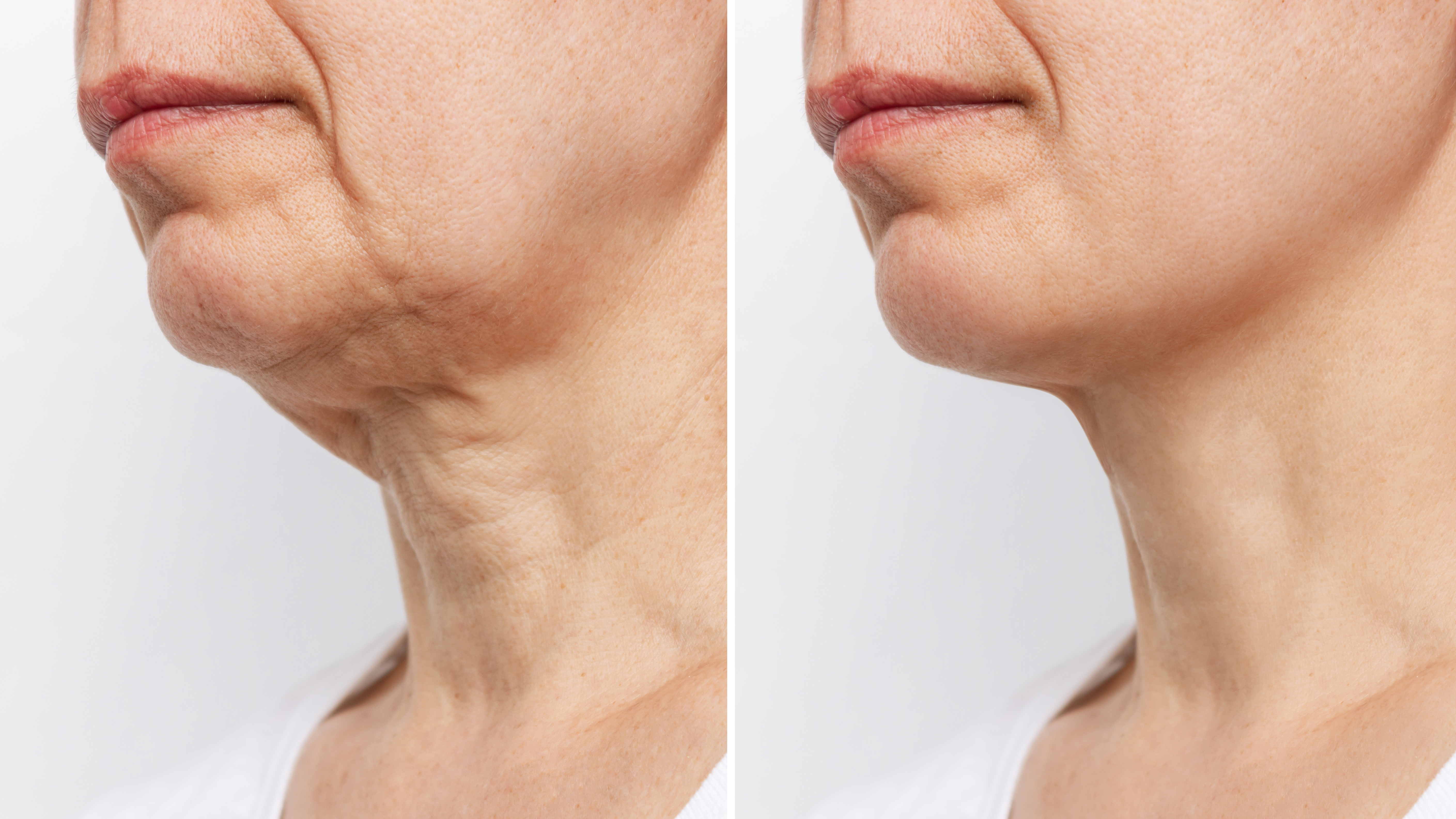 Lower part of the face and neck of elderly woman with signs of skin aging before and after facelift, plastic surgery on white background. Age-related changes, flabby sagging skin, wrinkles, creases