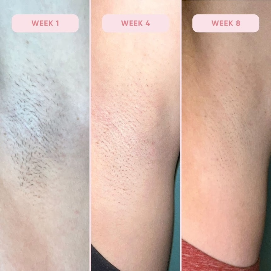 RoseSkinCo. Lumi Permanent Hair Removal Device