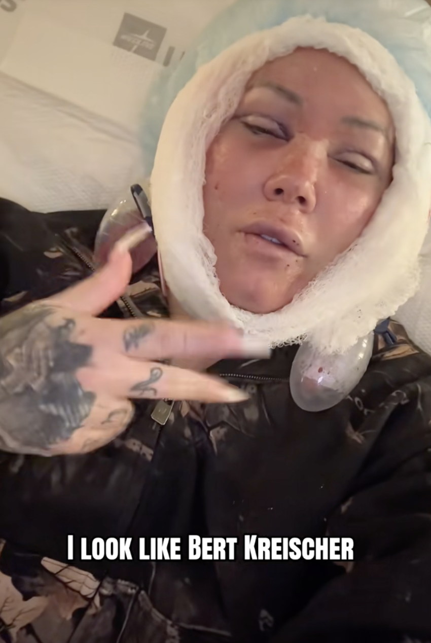 Jelly Roll's Wife Bunnie Xo Reveals Brutal Facelift Recovery
