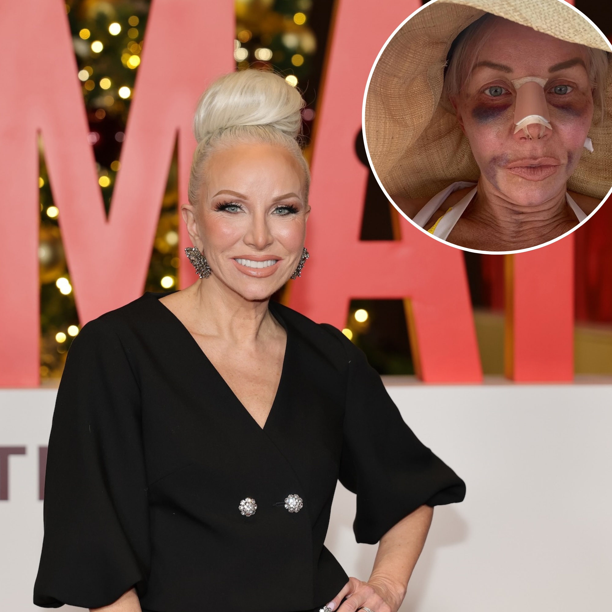 Real Housewives of New Jersey's Margaret Josephs Details 'Brutal' Bruising After Secret Nose Job