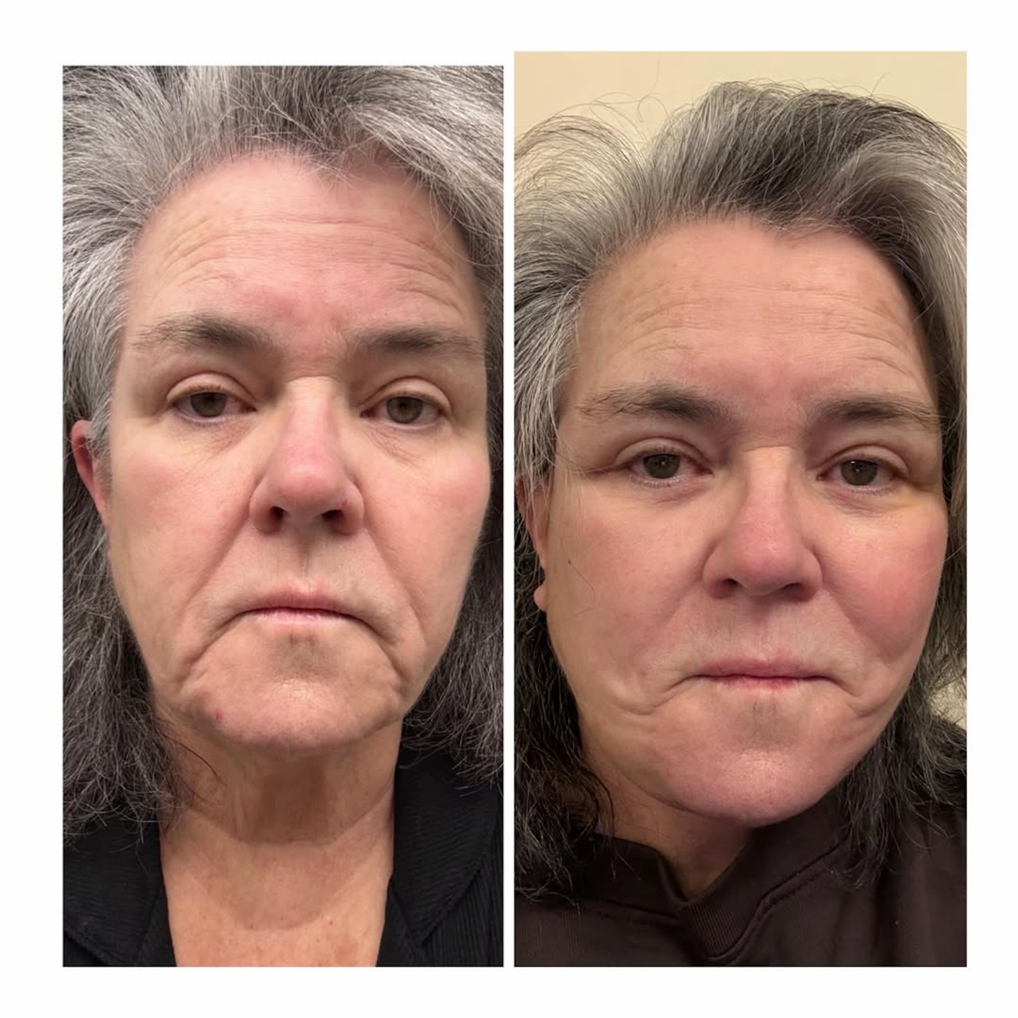 Rosie O'Donnell Shares Before-And-After Photos of Facelift 1 Day After Revealing Cosmetic Procedure